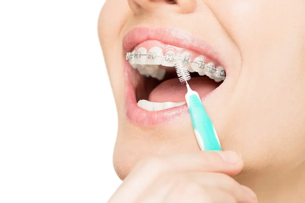 How To Maintain Proper Orthodontic Hygiene At Home?
