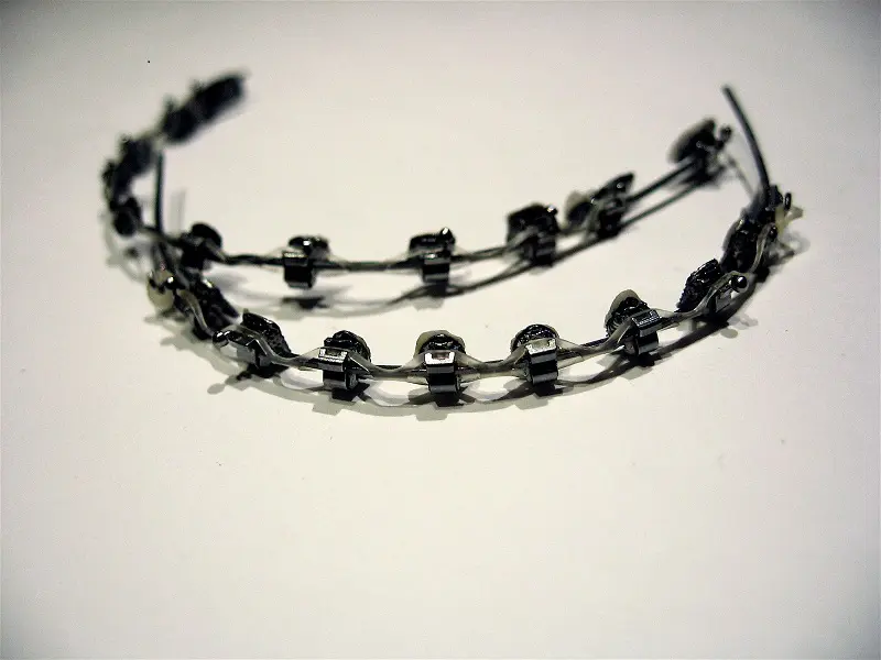 Types Of Braces And Their Pros And Cons