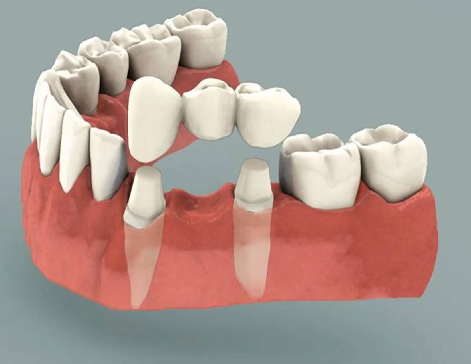 Dental Bridges – How Can They Help You?