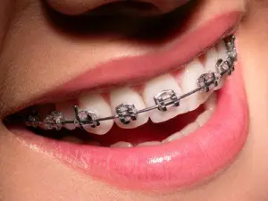 Things You Must Know Before Getting New Braces