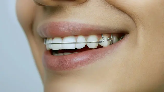 Gum Swelling While Wearing Braces