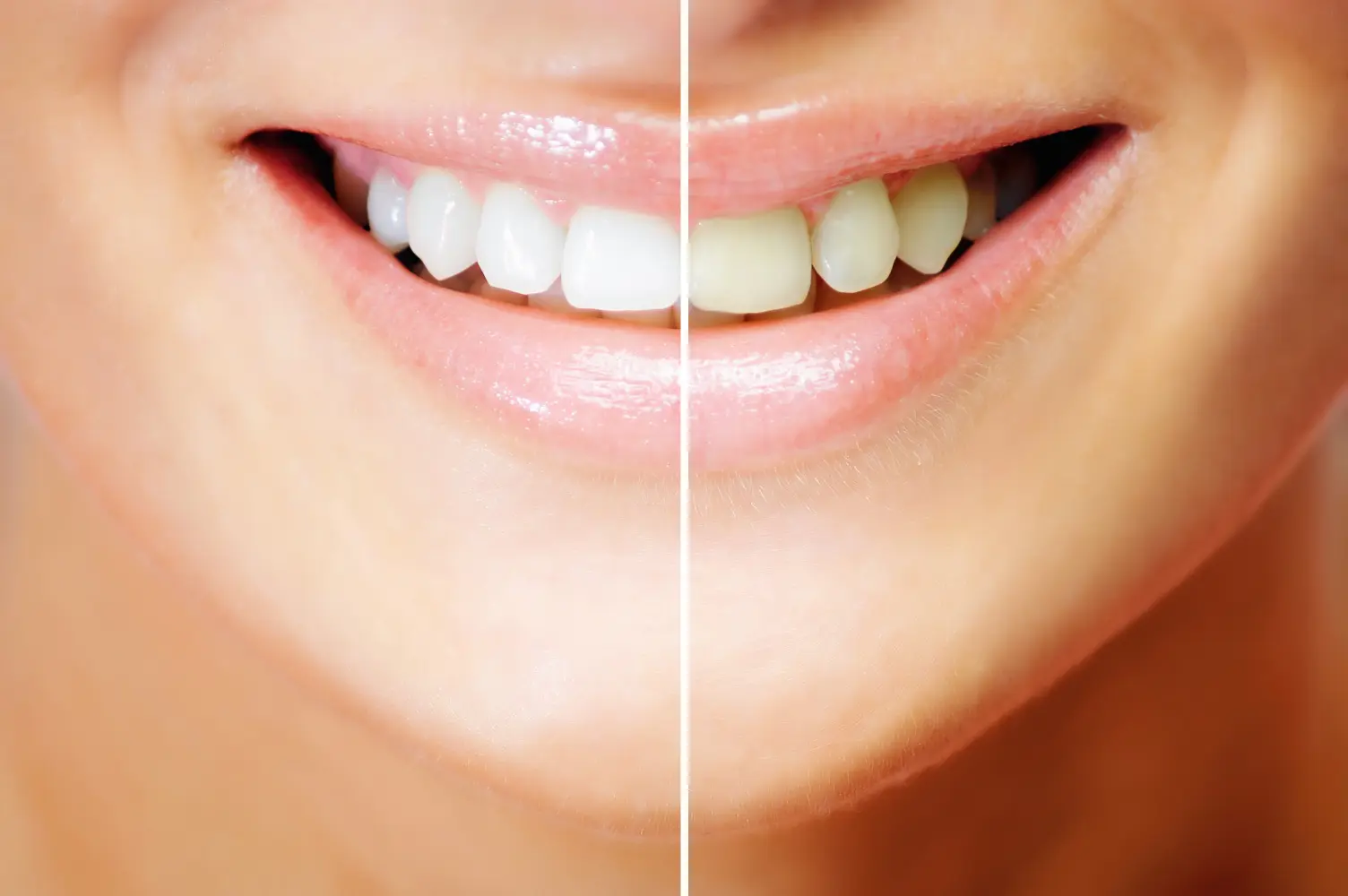 How Does Tooth Whitening In Bellevue Works?
