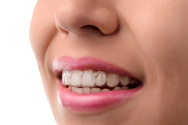 Top Invisalign Doctor Puyallup
