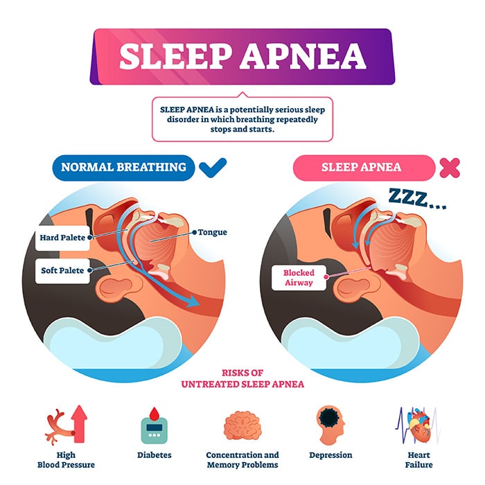 Sleep Apnea Vector Illustration