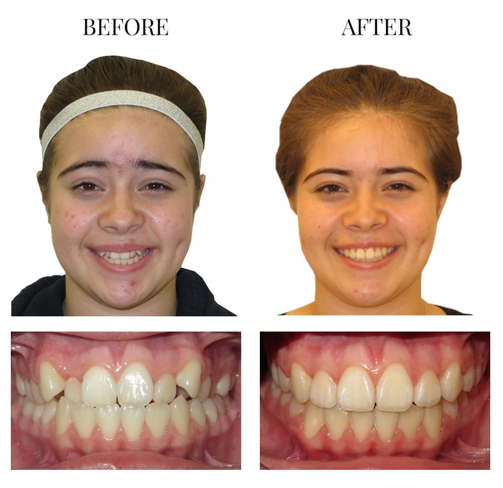 Underbite Treatment Before After