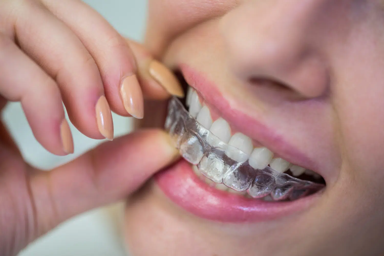 Invisalign In Puyallup Wa: How Long Do You Wear Invisalign For?